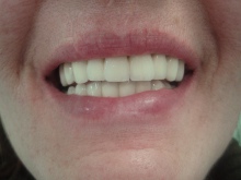 Cosmetic dentistry