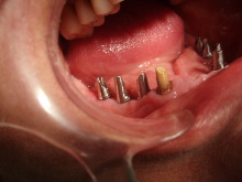 Implantology